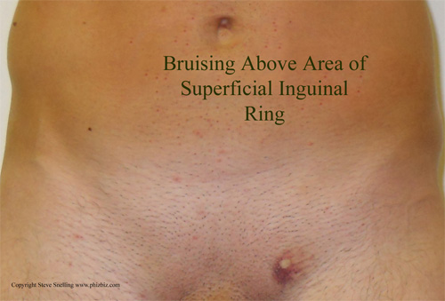 Bruising coming through superficial inguinal ring of the abdominal connective tissue of a patient