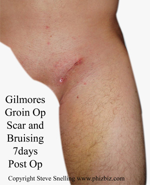 typical scar and bruising 7days following a Gilmores Groin operation